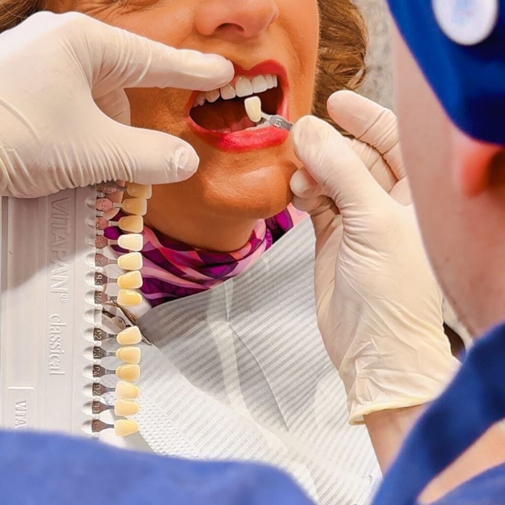 Faccette dentali a Forlì - Hollywood smile