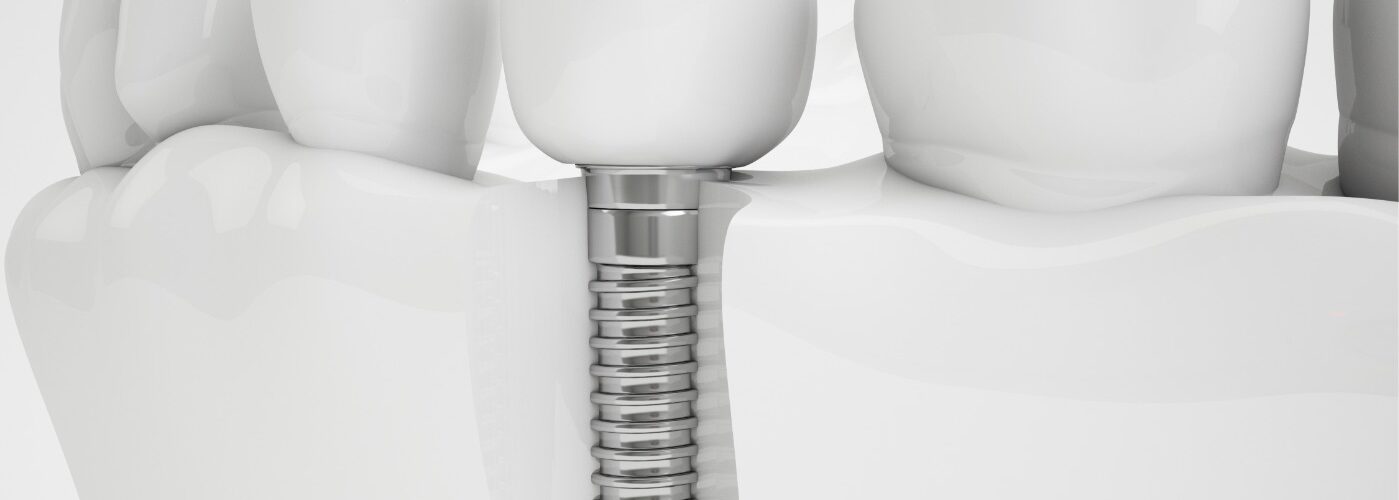 Implantologia | Studio Dentistico Valdinoci