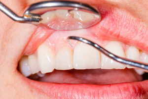 Parodontite | Studio Dentistico Valdinoci