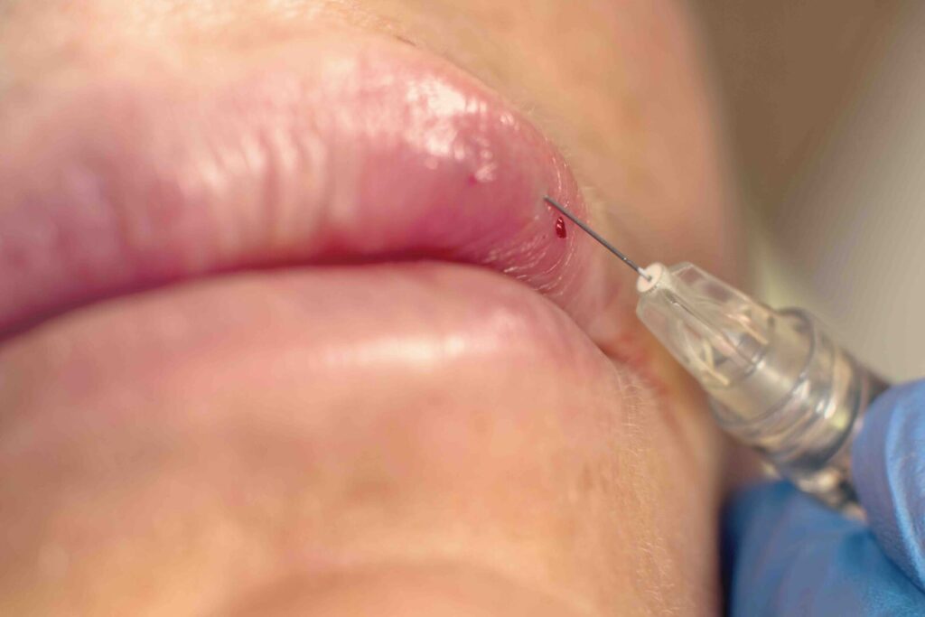 Filler labbra e lividi: come prevenirli prima e dopo il trattamento 1 filler labbra e lividi