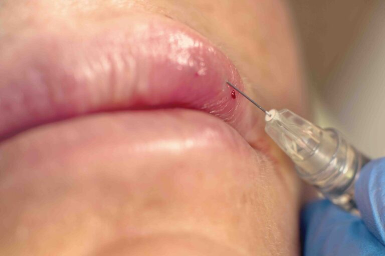filler labbra e lividi filler labbra e lividi